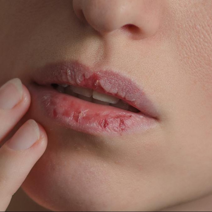 034237400_1558614682-iStock-900475418 bibir kering